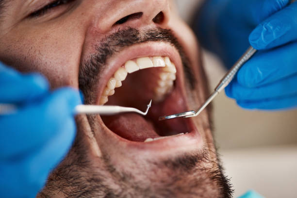 Best Broken or Chipped Tooth Repair in Mcalmont, AR